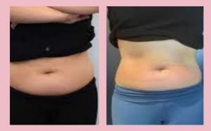 Cryoskin Before And After Stomach