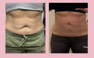 Cryoskin Before And After Stomach