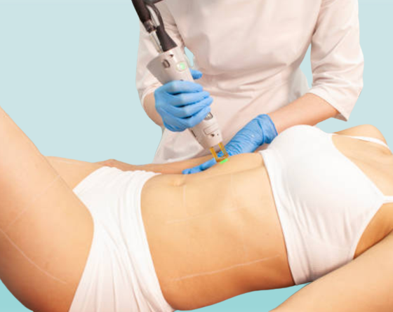 Stomach Laser Hair Removal