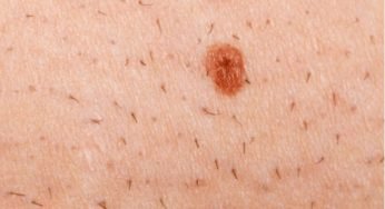 How to Remove Dead Skin After Microneedling